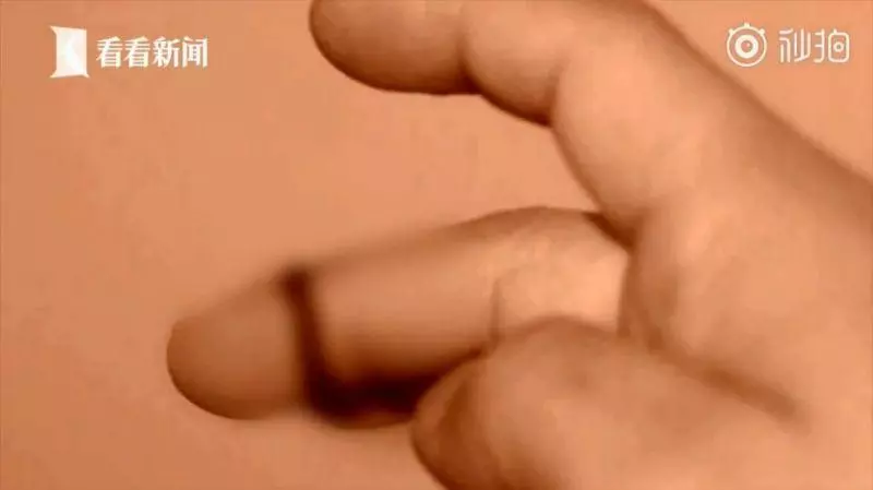 處理蝦尾手指被刺 婦「雙腿出血」器官衰竭亡