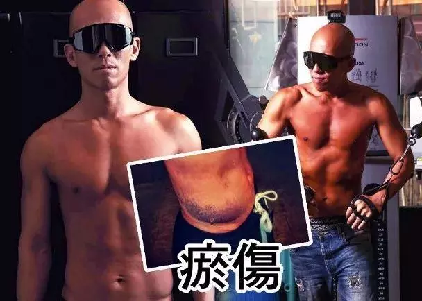 曾憑《使徒行者》人氣急升,如今為新戲拍攝致腰部大面積瘀傷!