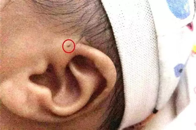 你家孩子耳朵上有「富貴洞」嗎?如果有,可要當心了!