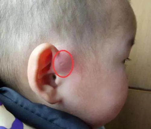 你家孩子耳朵上有「富貴洞」嗎?如果有,可要當心了!