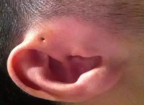你家孩子耳朵上有「富貴洞」嗎?如果有,可要當心了!