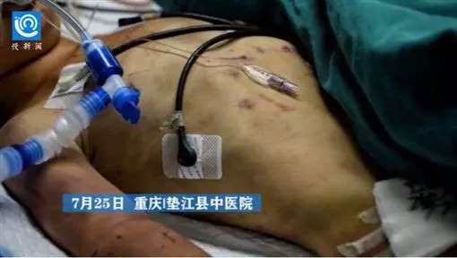 奶奶長期虐待 5歲童被毒打昏迷家中