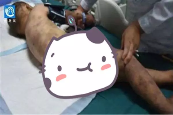 奶奶長期虐待 5歲童被毒打昏迷家中