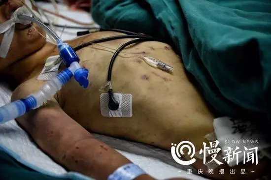 男童疑遭奶奶長期毒打 母親:婆媳關系不和遷怒孩子