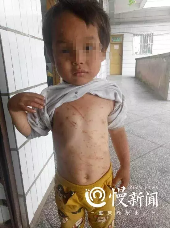 男童疑遭奶奶長期毒打 母親:婆媳關系不和遷怒孩子