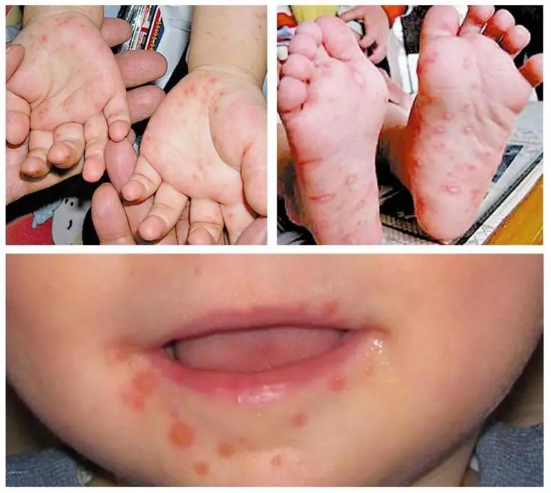 大馬第一個【手足口症】死亡案例!檳城Baby感染EV71病毒去世,爸爸媽媽要警惕!