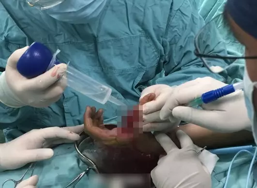 打開汽水瓶蓋 男手指被炸到骨折