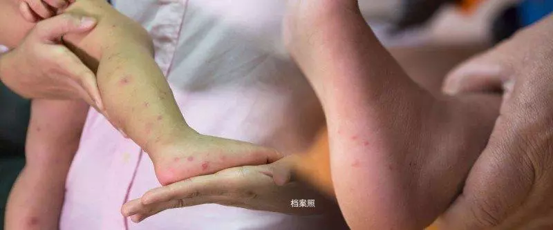 手足口症肆虐全國！確診病例已接近4萬宗！