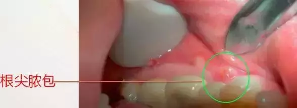 孩子蛀牙並不全是因為吃糖,這些原因容易被忽視!