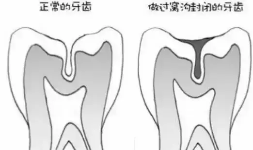 孩子蛀牙並不全是因為吃糖,這些原因容易被忽視!
