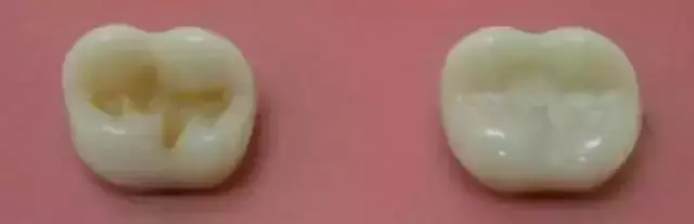 孩子蛀牙並不全是因為吃糖,這些原因容易被忽視!