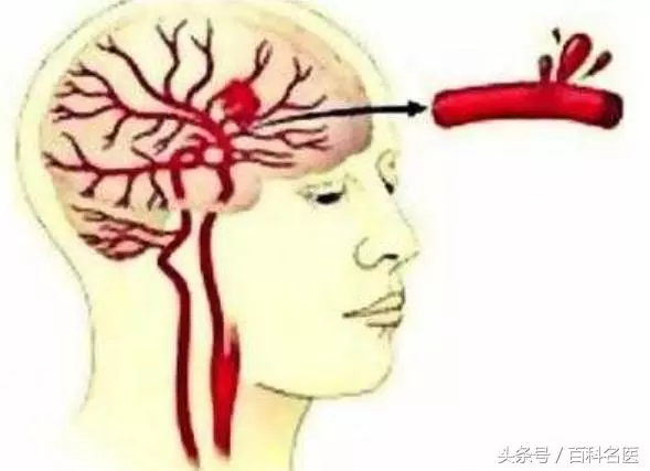 噩耗!著名演員看世界盃突發腦溢血,被絕殺?6類人慎看世界盃!