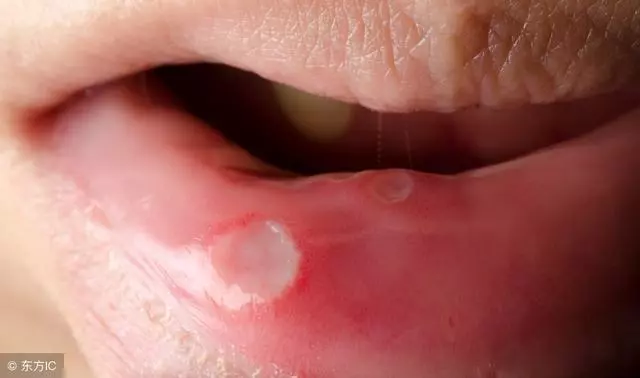 口腔潰瘍疼痛難忍?老中醫教你幾招,效果立竿見影!