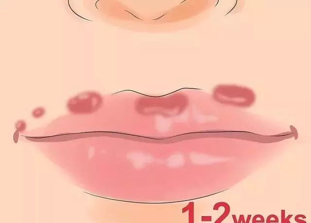 嘴上長泡,暗藏6種致命疾病,做對5件事清火排毒