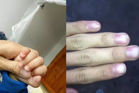 肝臟鬧脾氣,手上會發出4個「求救信號」!常吃2種野草助你養好肝