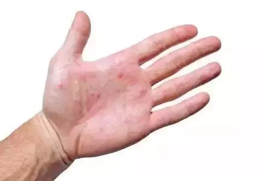 肝臟鬧脾氣,手上會發出4個「求救信號」!常吃2種野草助你養好肝