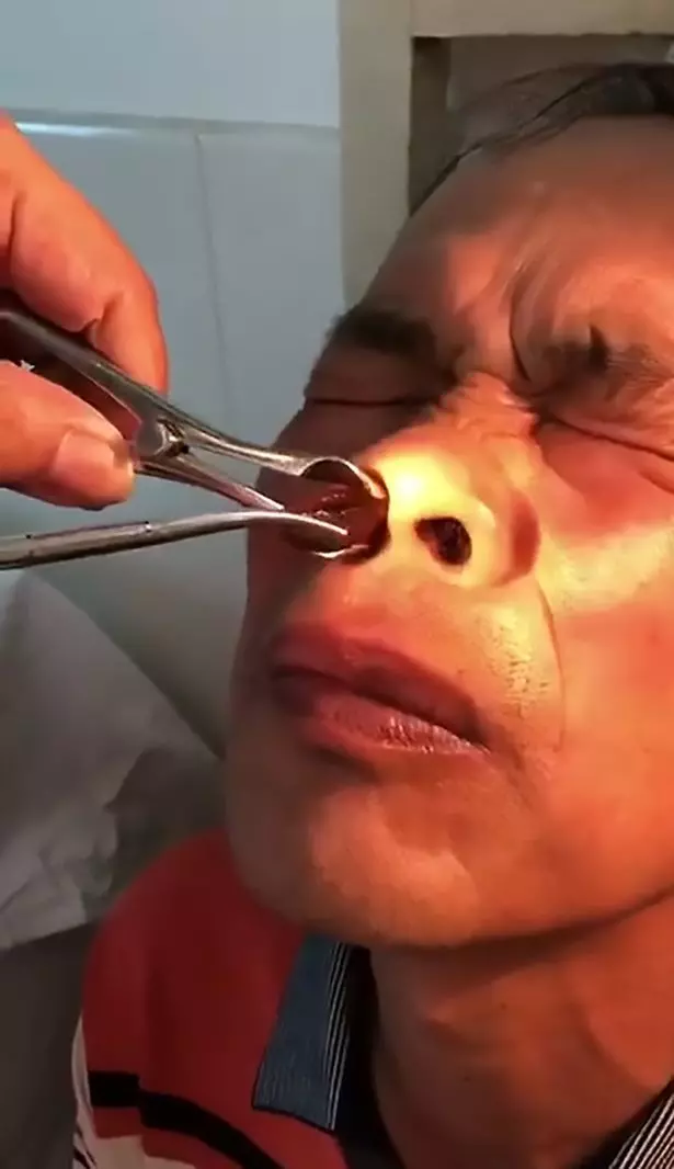 夾子在強國男鼻孔狂撈…夾出「巨大活體木耳」超噁爛蠕動!他看著看著竟露出勝利微笑…(影)