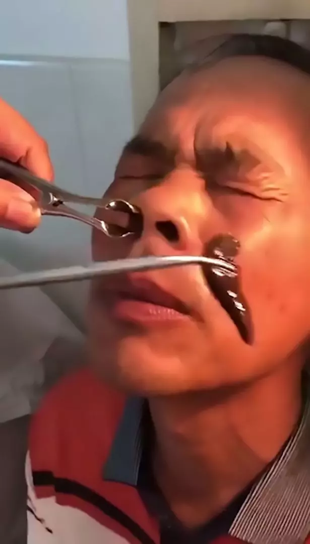 夾子在強國男鼻孔狂撈…夾出「巨大活體木耳」超噁爛蠕動!他看著看著竟露出勝利微笑…(影)