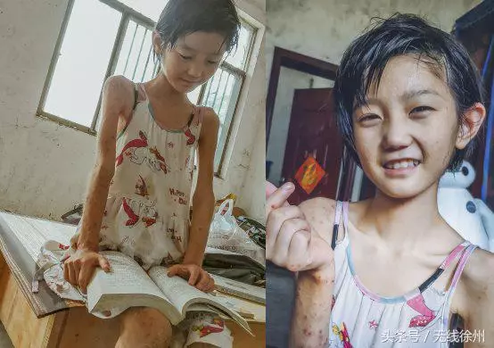 她的笑容如此明媚13歲身患罕見病女孩夢婷有個小小的心願……