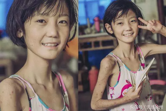 她的笑容如此明媚13歲身患罕見病女孩夢婷有個小小的心願……