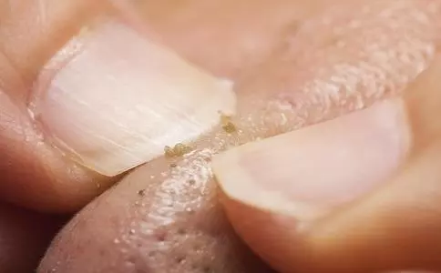 身上出現這「5個信號」,說明有「蟎蟲」!第3個很多人有,還不趕緊除蟎蟲,小心臉被毀掉! - 讀讀