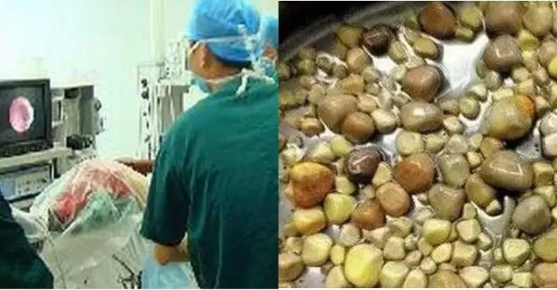 恐怖!55歲男人體內取出「420顆 」腎結石!!只因他長年吃「這個東西」醫生看完差點嚇暈!我們卻天天都在吃 - 讀讀