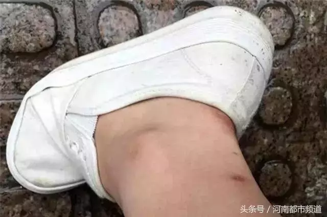 聚餐時感覺被扎了一下,28歲女子險些猝死!近期病例多發,要當心 - 讀讀