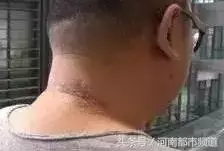 聚餐時感覺被扎了一下,28歲女子險些猝死!近期病例多發,要當心 - 讀讀