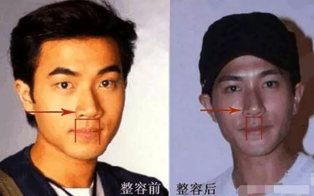 女星整容算什麼?劉愷威面癱程度再升級,而他直接90萬「換臉」!