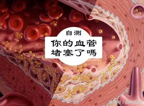 如果有這「5個癥狀」說明你的血管已經堵塞了!不容忽視,這「5種食物」快吃起來 - 讀讀