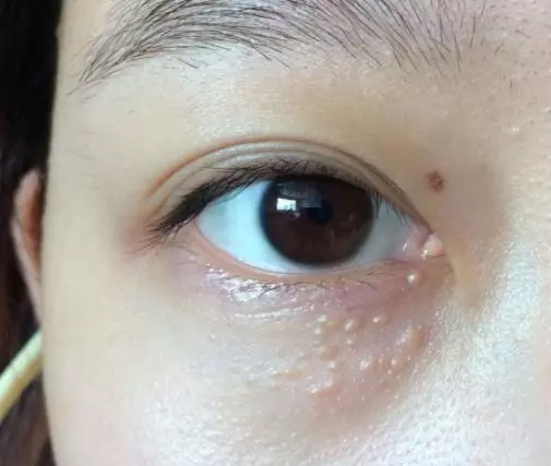 身上經常長【小肉疙瘩】很醜很煩惱,教你2小招,輕鬆消除不再生