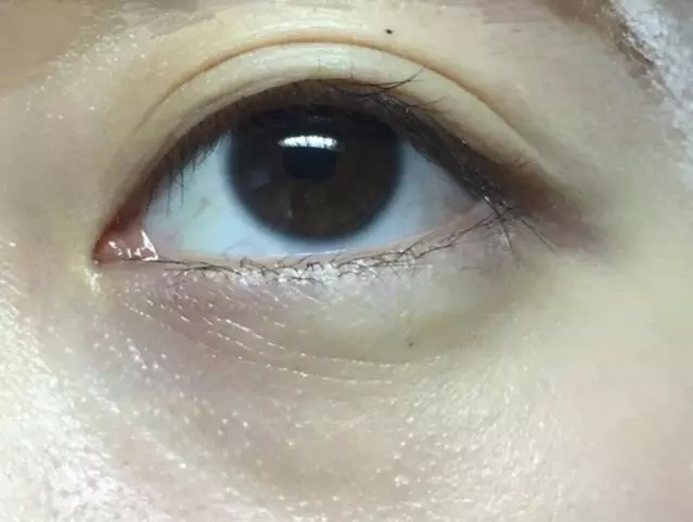 身上經常長【小肉疙瘩】很醜很煩惱,教你2小招,輕鬆消除不再生