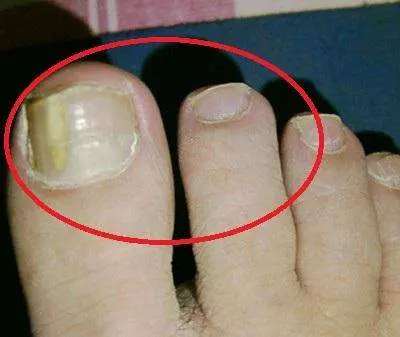 「腎」不好腳知道,如果腳上沒有這4個表現,恭喜!你的腎很健康