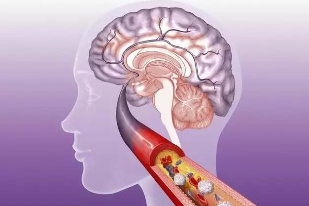 腦血栓的「天然清理工」,經常吃一點,血管幹凈,血栓不來擾