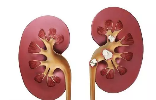 腎結石不用怕,它們是純天然「粉碎機」,還你健康腎先生!