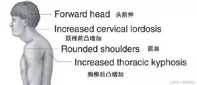 總是覺得「脖子緊」?朋友,請小心上交叉綜合症