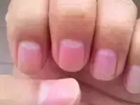 指甲上的月牙、豎紋、白點代表什麼?