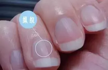 指甲上的月牙、豎紋、白點代表什麼?