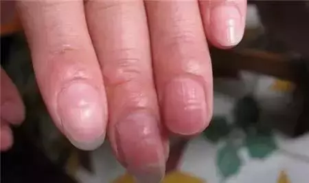 指甲上的月牙、豎紋、白點代表什麼?