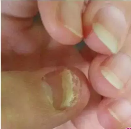 指甲上的月牙、豎紋、白點代表什麼?