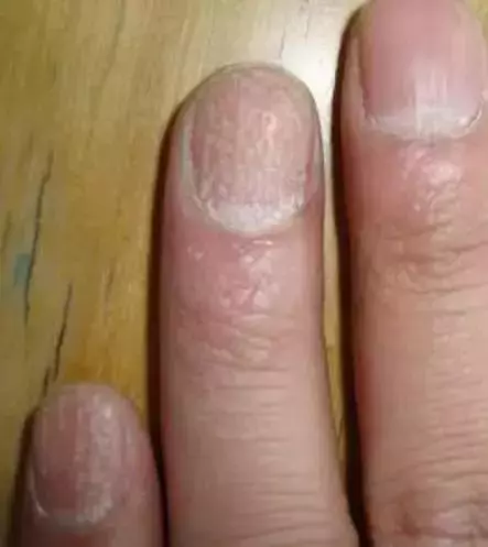 指甲上的月牙、豎紋、白點代表什麼?