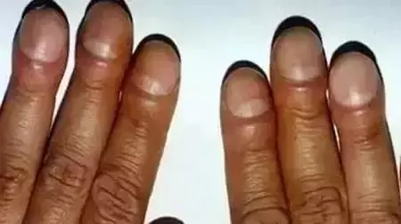 指甲上的月牙、豎紋、白點代表什麼?