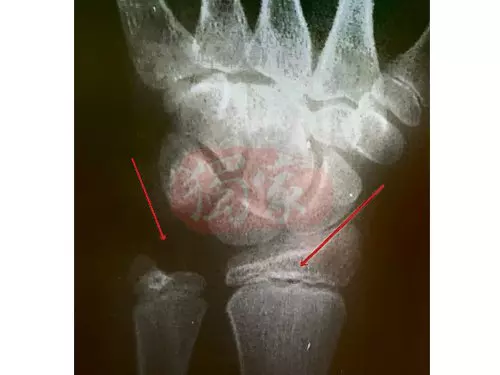 老師體罰用牛力 學生腕骨被打斷