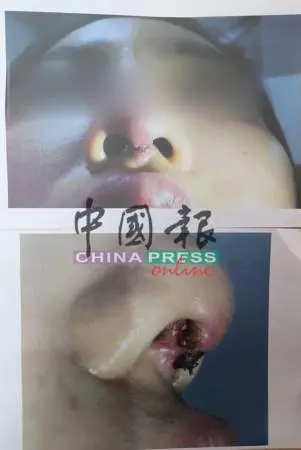 女子微整形遇惡霸老闆娘 手術後發炎 投訴竟遭恐嚇
