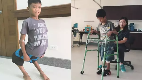 菲男童腿部畸形 赴美動手術成功 積極治療
