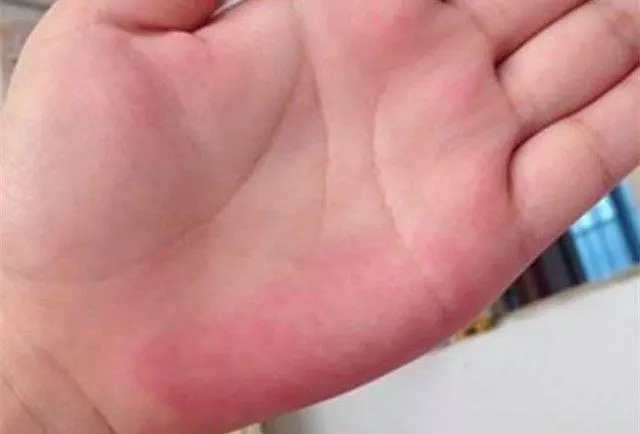 肝臟不好,手上會發出5個信號,做到「3少3多」,肝臟慢慢變好!