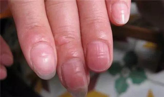 肝臟不好,手上會發出5個信號,做到「3少3多」,肝臟慢慢變好!