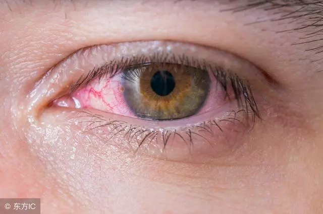 早上起床眼乾、眼屎多,可能預示5種病!希望你別等出事才發現