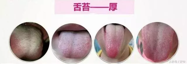 濕氣的典型變現是什麼?快來對照查查!