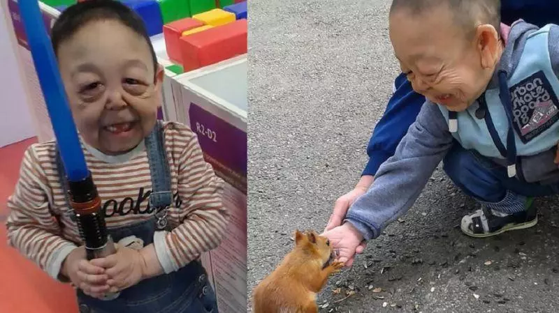 鼻酸!先天性罕見疾病 6歲男童面容衰老如80歲 - COCO大馬